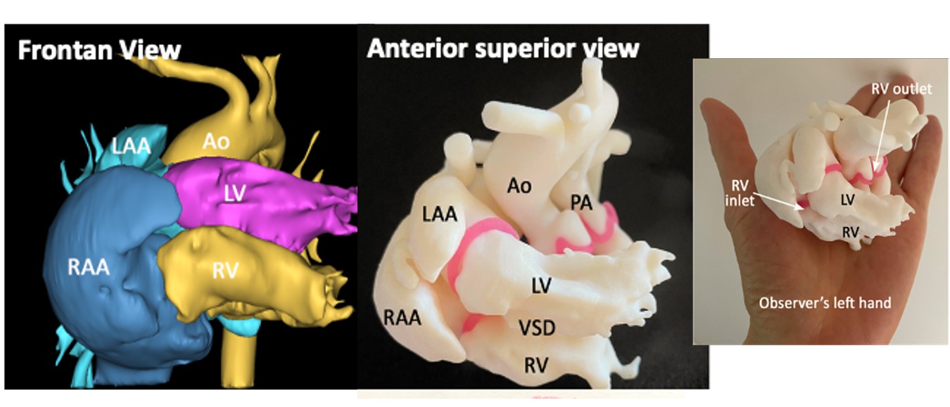 Concordant Atrioventricular Connection to L-Looped Ventricles with the Left Ventricle on Top of the Right Ventricle in Situs Solitus: A Case Report with 3D Modelling and Printing