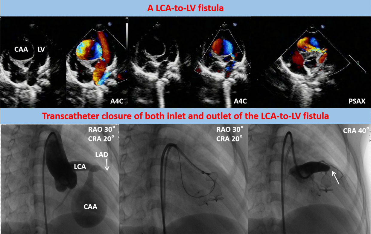 A Rare Case of Transcatheter Closure of Both Inlet and Outlet of a Left Coronary Artery-to-Left Ventricular Fistula with Giant Coronary Artery Aneurysm